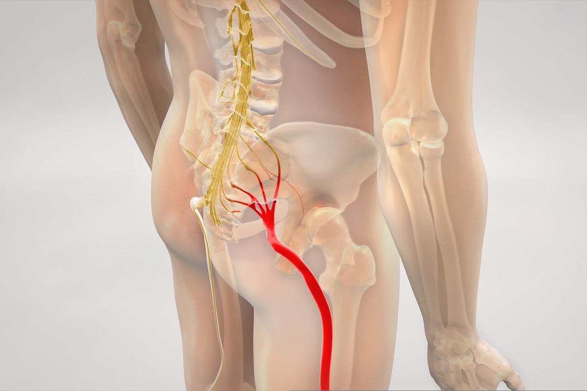 sciatica